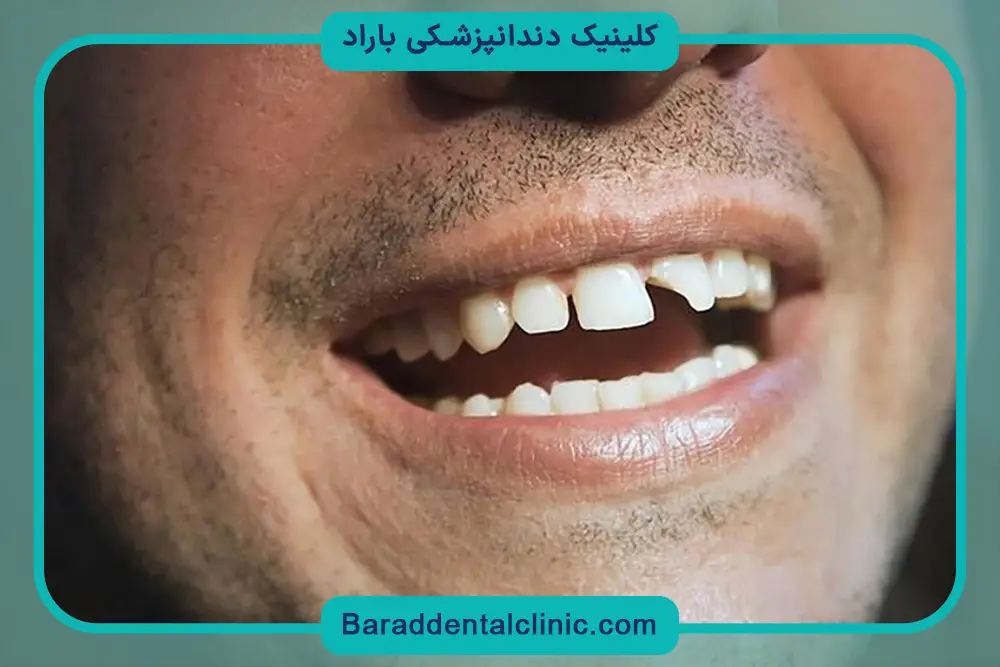 بازسازی دندان شکسته