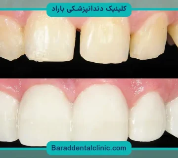 خرید باندینگ دندانپزشکی