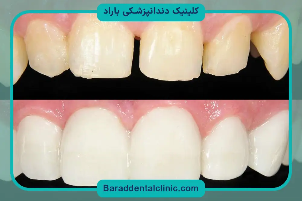 خرید باندینگ دندانپزشکی
