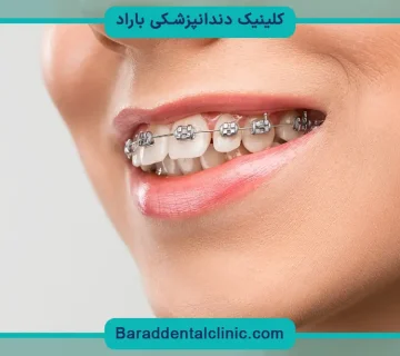 جایگزین سیم کشی دندان