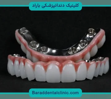 ایمپلنت تیتانیوم
