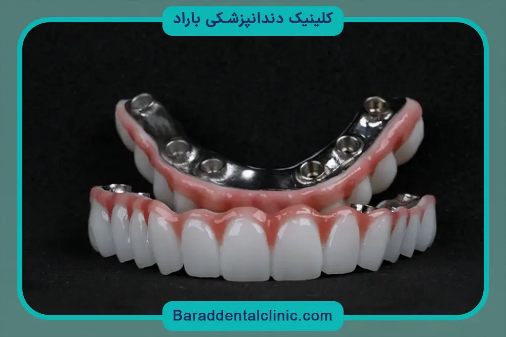 ایمپلنت تیتانیوم