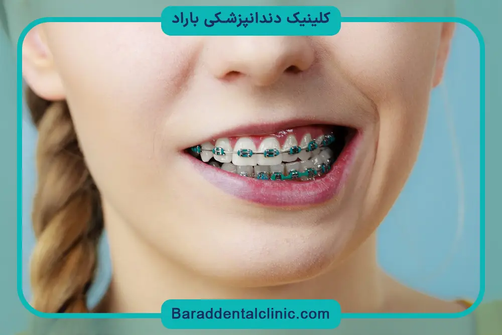 قیمت سیم کشی دندان جلو
