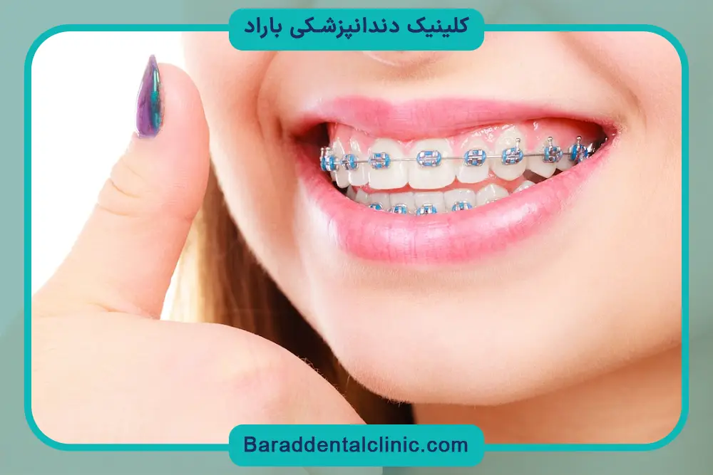 سیم کشی دندان چند تومان است