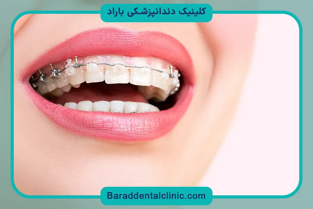 تاثیر سیم کشی دندان بر زیبایی