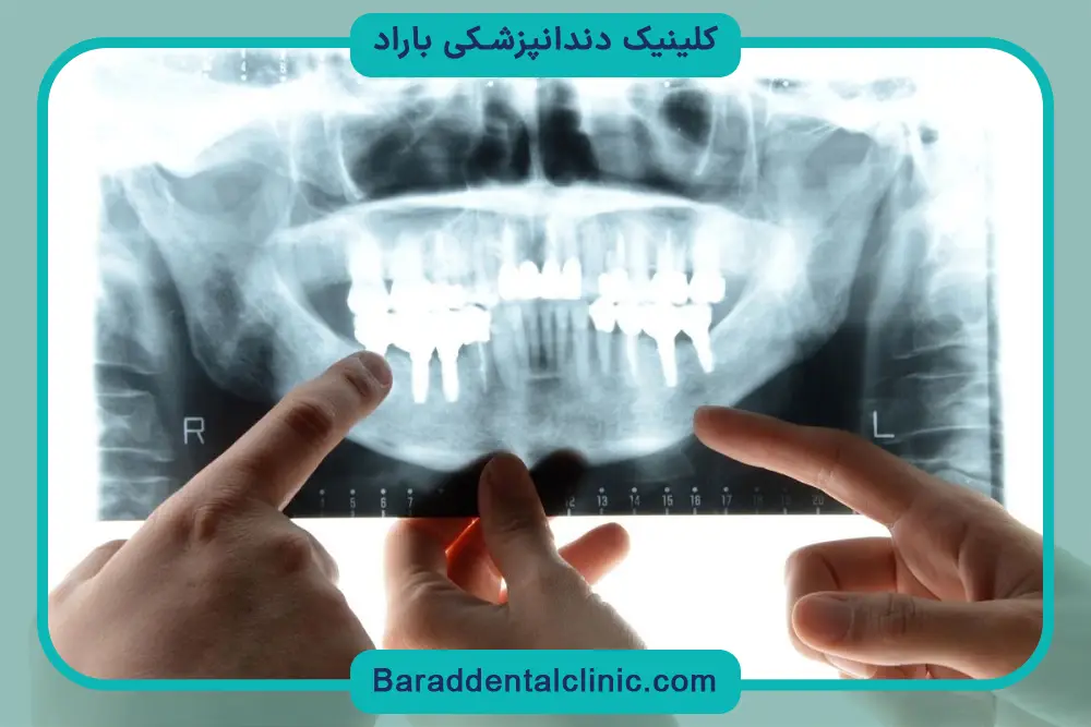 ایمپلنت دیجیتال چقدر طول میکشه؟ بررسی مراحل
