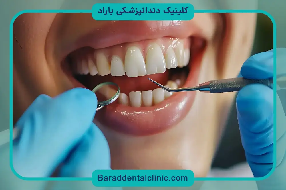 کامپوزیت ونیر چیست؟  بررسی کلی