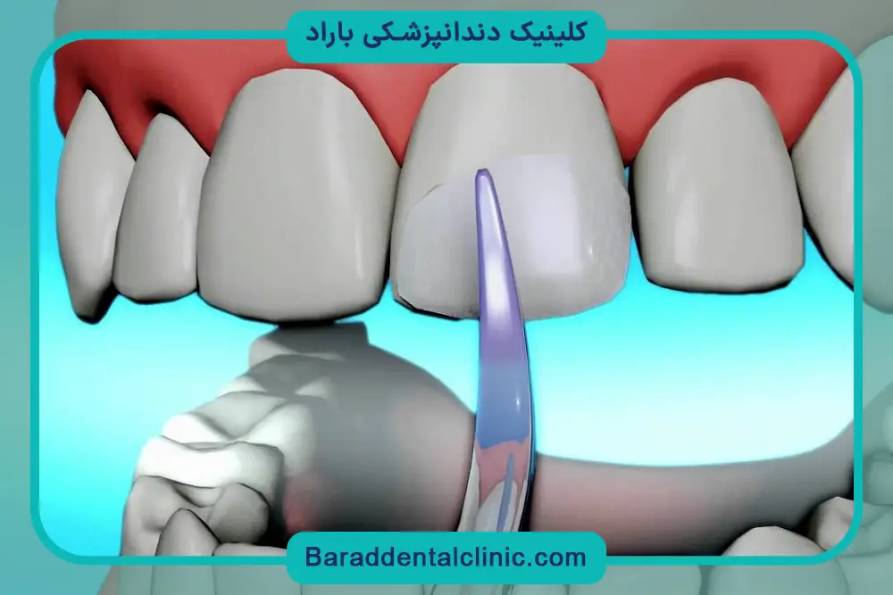 بررسی قیمت باندینگ دندان 