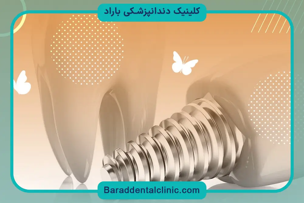 بررسی عمر ایمپلنت دیجیتال