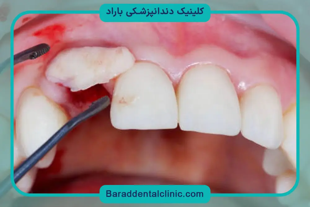 نحوه بازسازی دندان شکسته 
