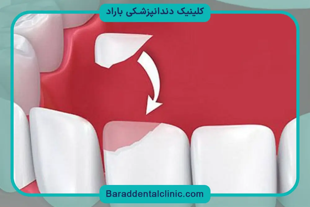 تعریف باندینگ دندان