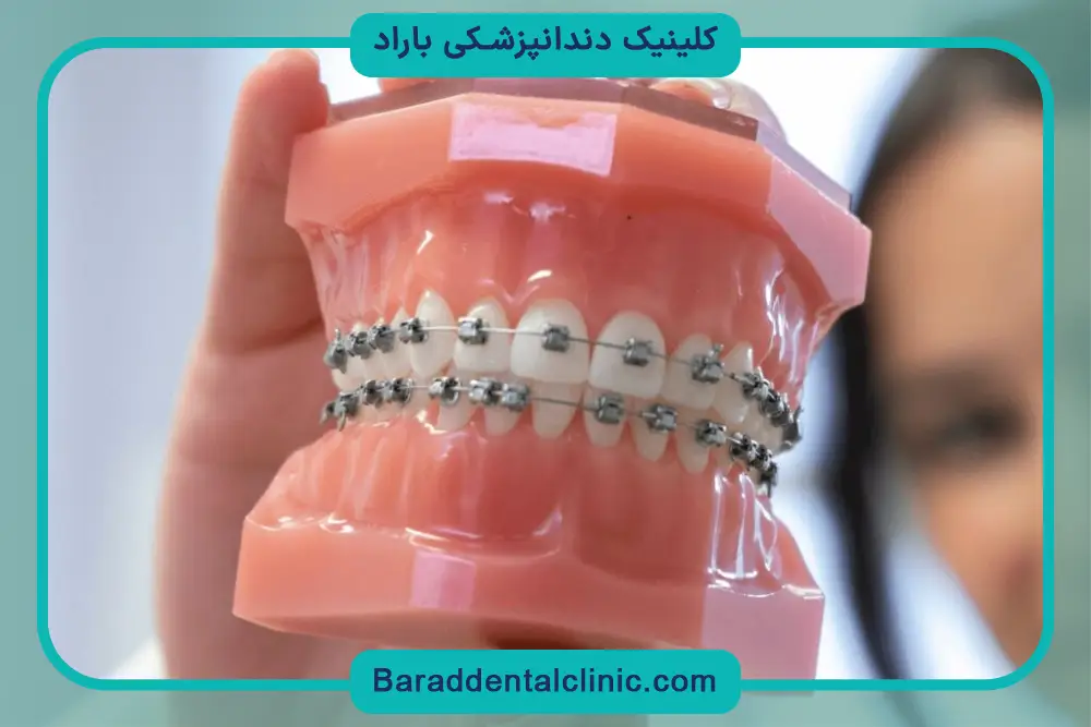 بررسی قیمت سیم کشی چهار دندان جلو 