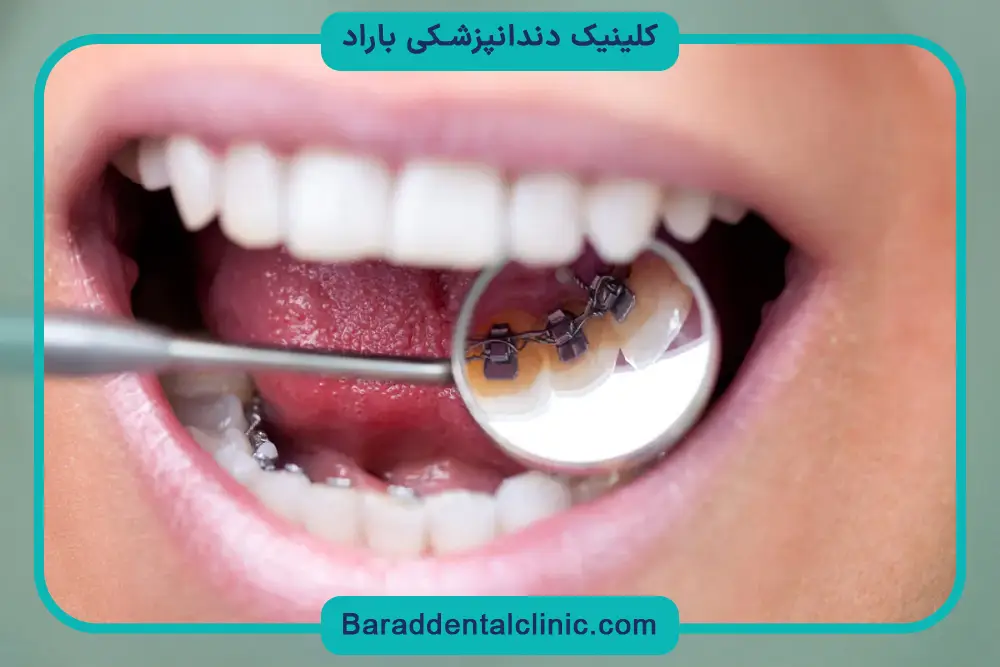 جایگزین سیم کشی دندان چیست؟