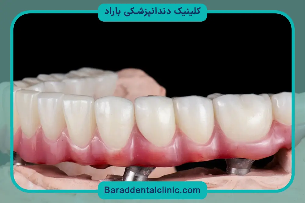 ایمپلنت تمام فک چیست؟