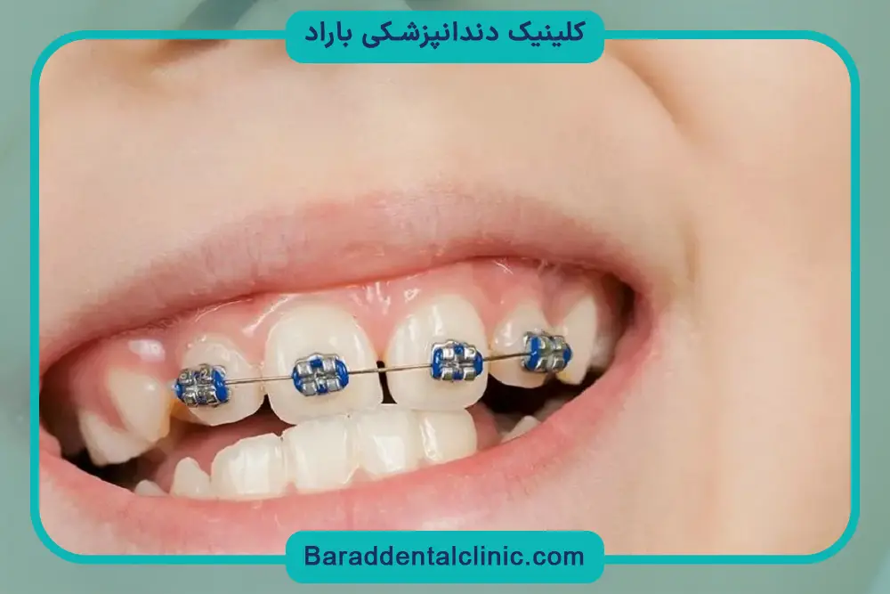 عوامل موثر بر قیمت سیم کشی دو دندان جلو 