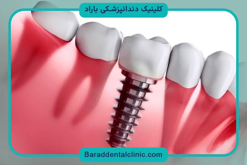 ایمپلنت فوری دندان چیست؟