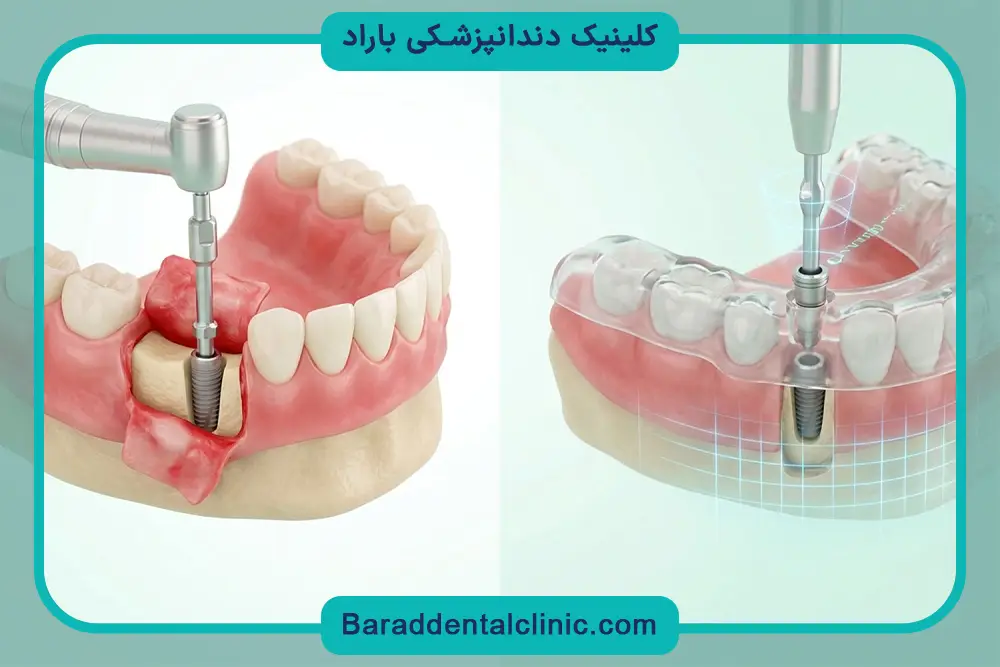 ایمپلنت جدید دیجیتال چیست؟