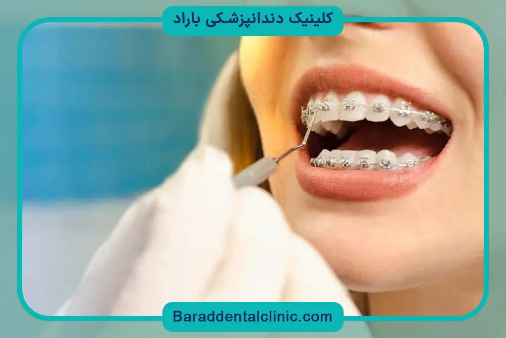 آیا سیم کشی دندان شامل بیمه تکمیلی میشود؟ 