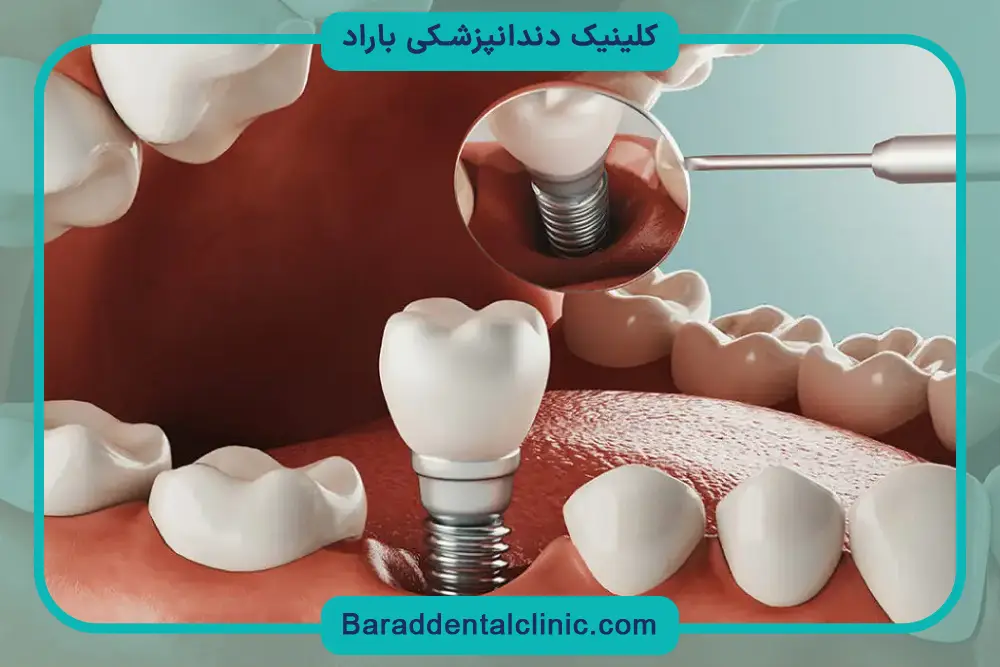 ایمپلنت دیجیتال دندان جلو چیست؟