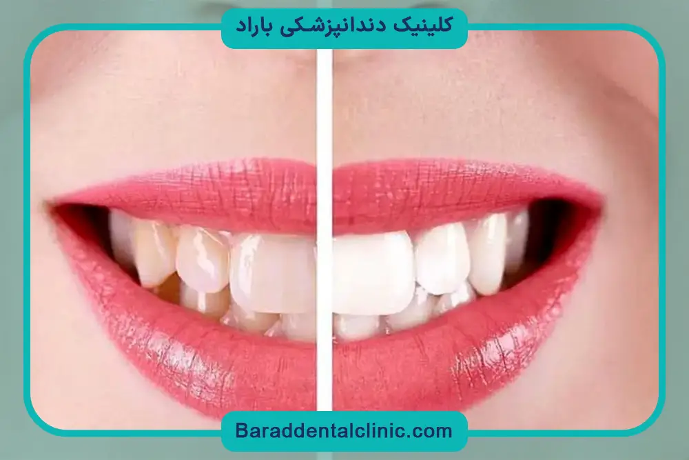 معایب کامپوزیت ونیر چیست؟ 