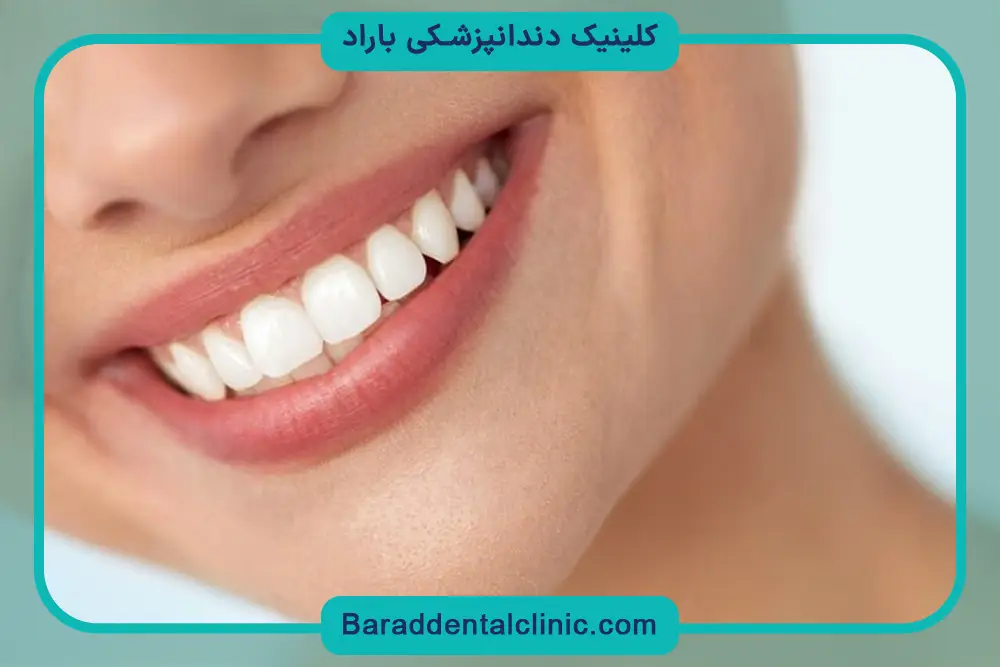 عوامل موثر بر قیمت باندینگ دندان 