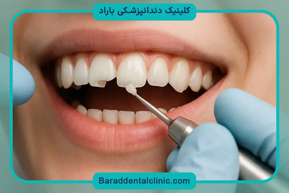 عوامل موثر بر هزینه باندینگ دندان جلو 