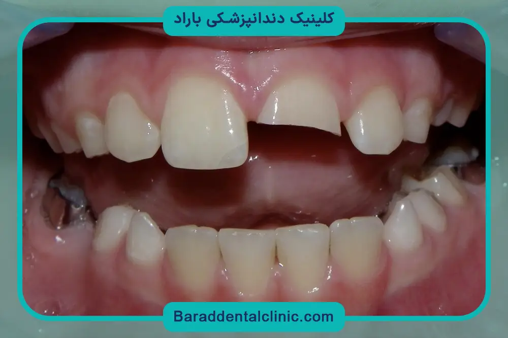 روش‌های بازسازی دندان شکسته 