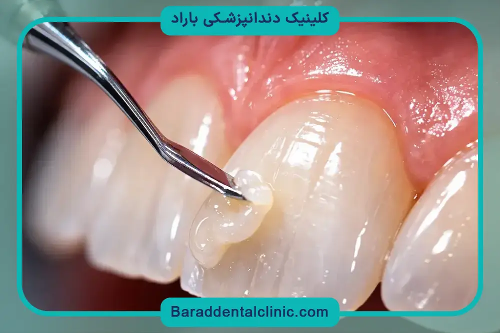 خرید باندینگ دندانپزشکی نسل 5