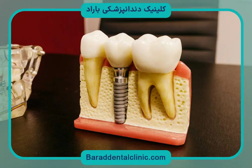 فرایند اتصال ایمپلنت تیتانیوم 