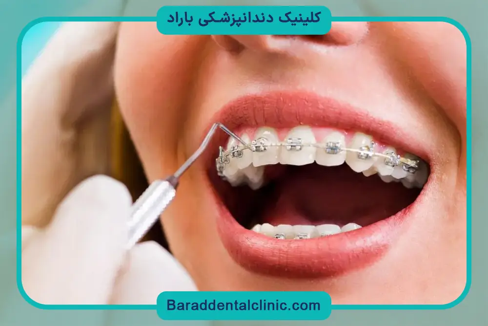 سیم کشی دندان چند تومان است؟ عوامل موثر بر قیمت