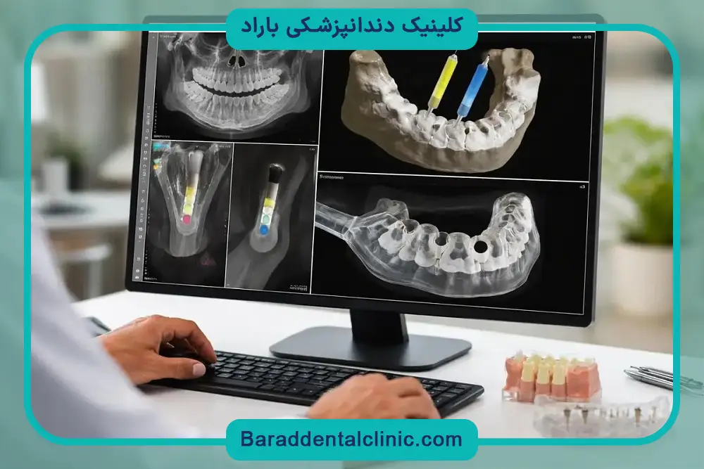 نحوه ایمپلنت جدید دیجیتال 