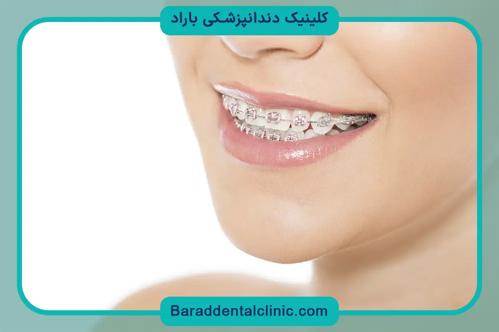 سیم کشی دندان شامل بیمه تکمیلی میشود؟ بررسی بیمه‌های تحت پوشش