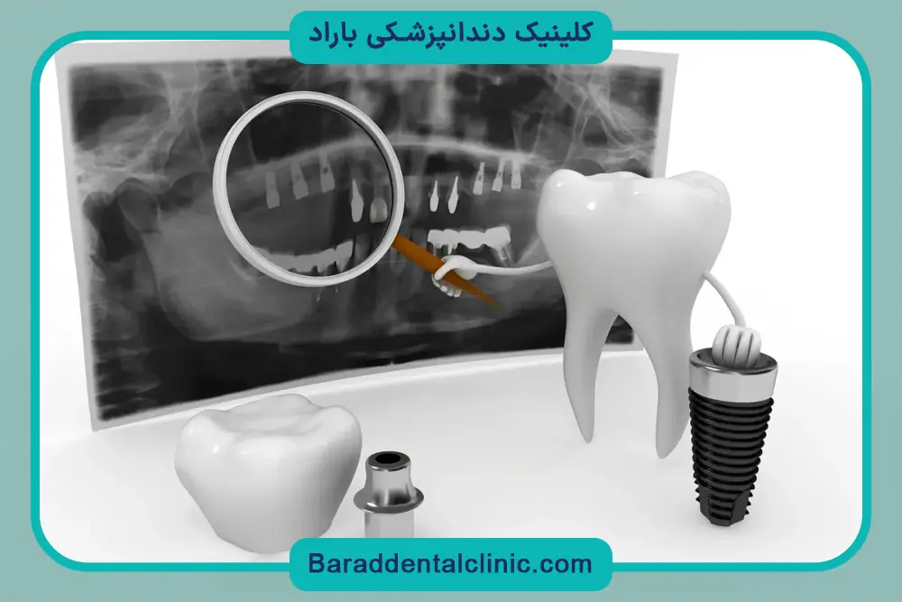 مشاوره ایمپلنت دیجیتال دندان جلو