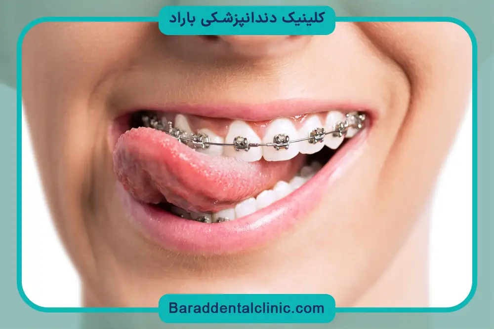 قیمت سیم کشی دندان در تهران براساس نوع ارتودنسی