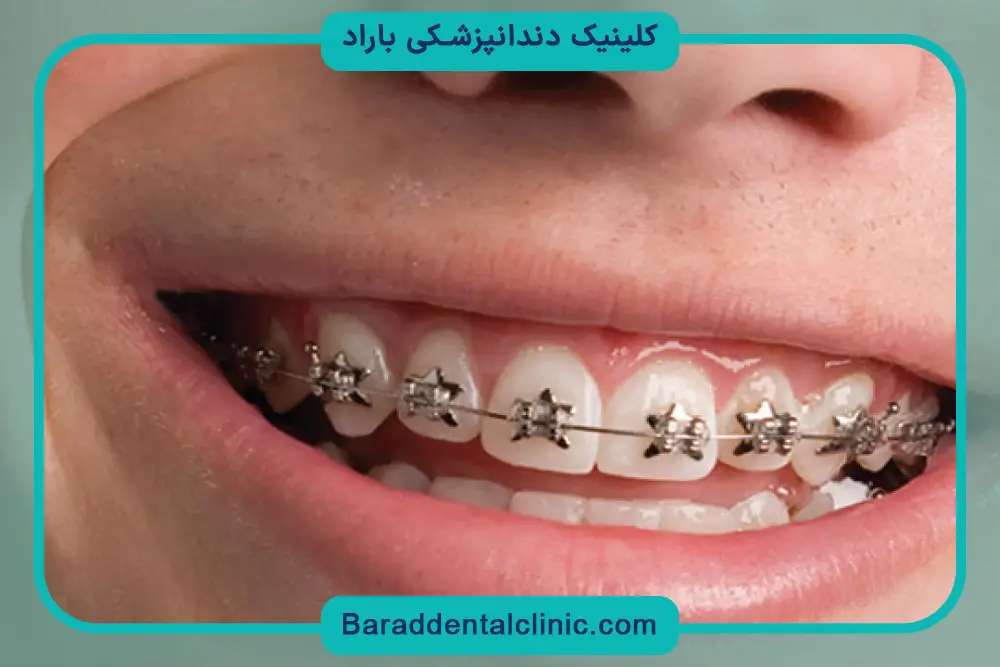 مراقبت‌های بعد از سیم کشی تک دندان 