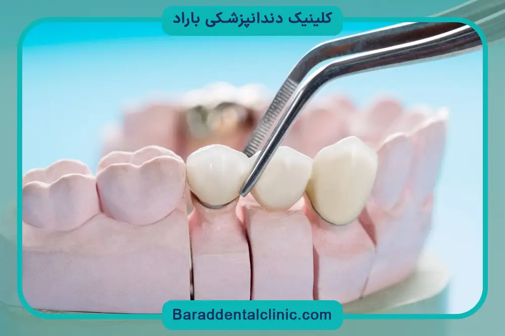 بررسی ماندگاری ایمپلنت فوری دیجیتال