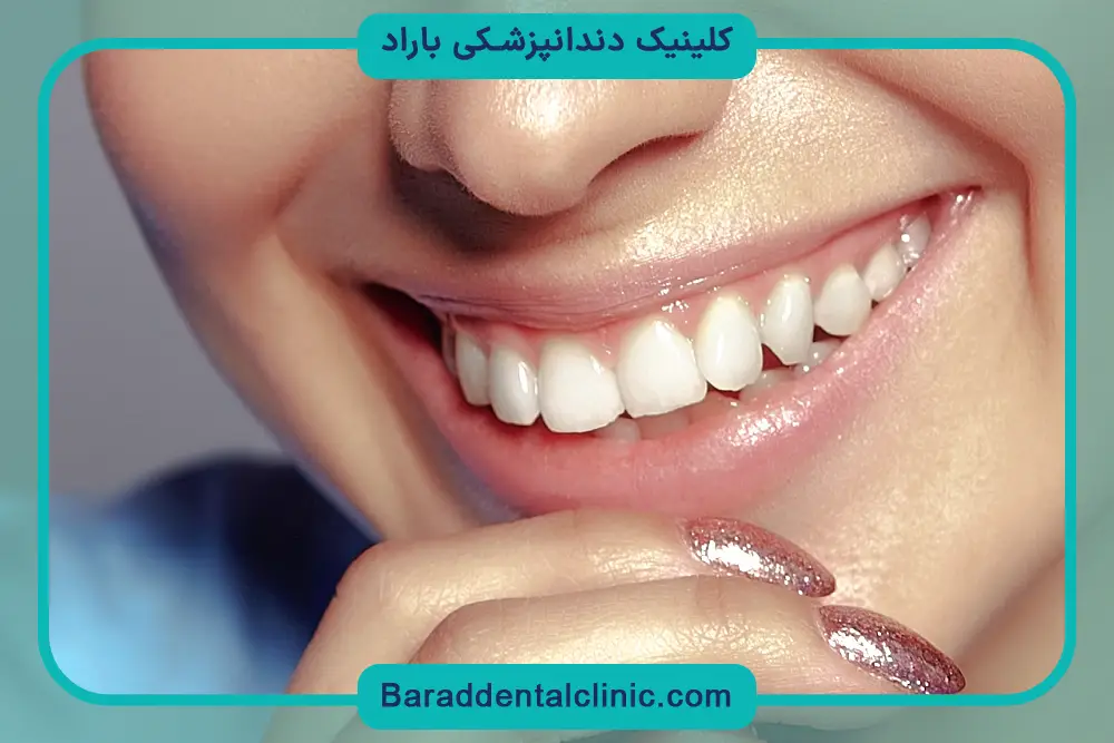 تفاوت لمینت با کامپوزیت ونیر چیست؟ 