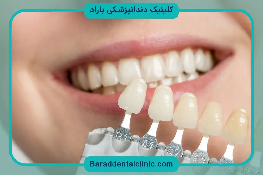 مقایسه قیمت باندینگ دندان با کامپوزیت و لمینت