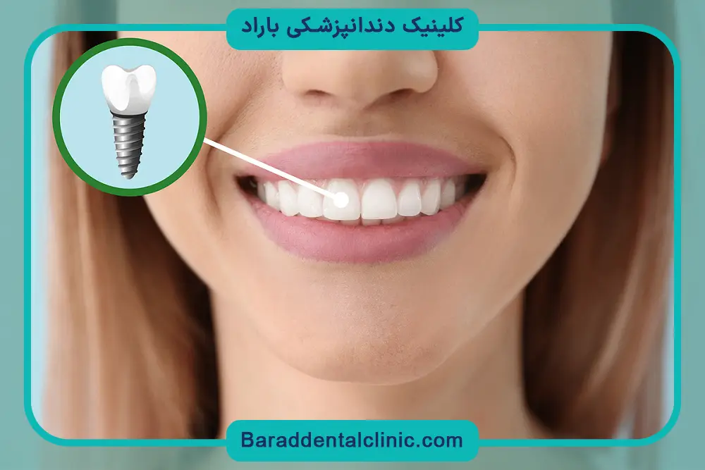 مراقبت‌های تاثیرگذار روی عمر ایمپلنت دیجیتال