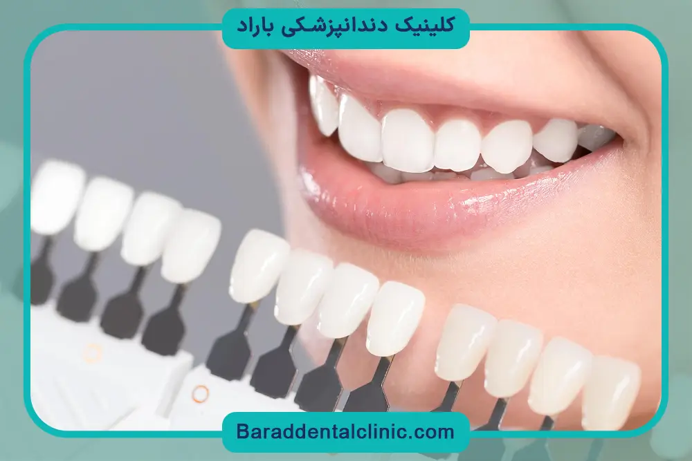 هزینه باندینگ دندان جلو برای اصلاح فاصله