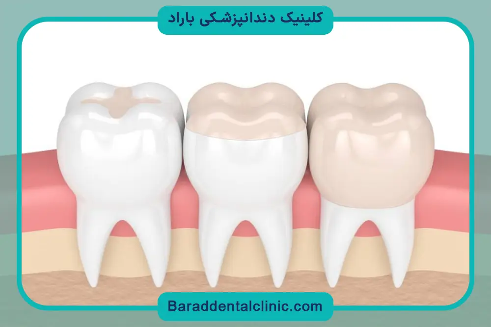 خرید باندینگ دندانپزشکی یونیورسال