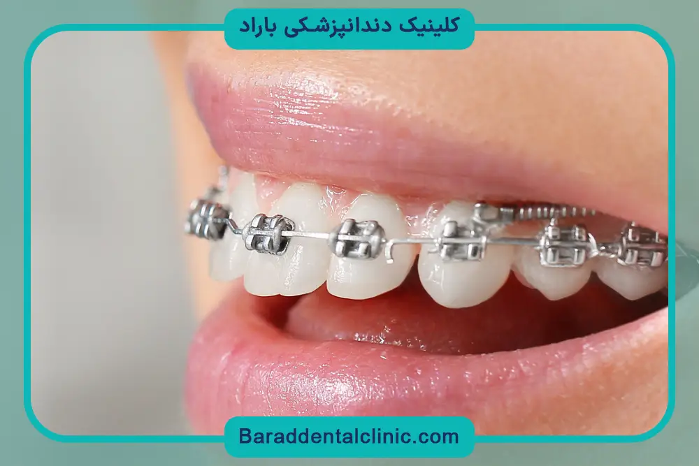 پوشش قیمت سیم کشی چهار دندان جلو  توسط بیمه