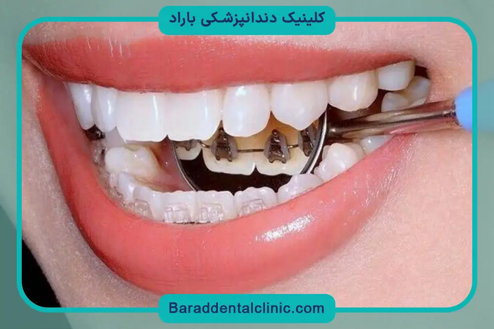 ارتودنسی متحرک یک جایگزین سیم کشی دندان 
