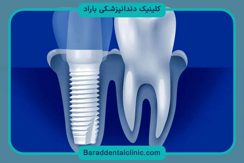 ماندگاری ایمپلنت تیتانیوم 
