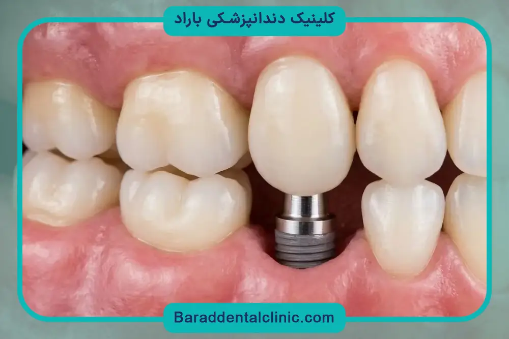 نیاز به پیوند استخوان در ایمپلنت تمام فک 