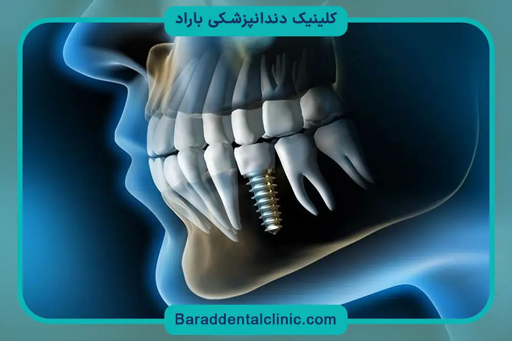 دوره نقاهت ایمپلنت جدید دیجیتال 