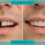 ایمپلنت ثابت دندان