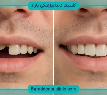 ایمپلنت ثابت دندان