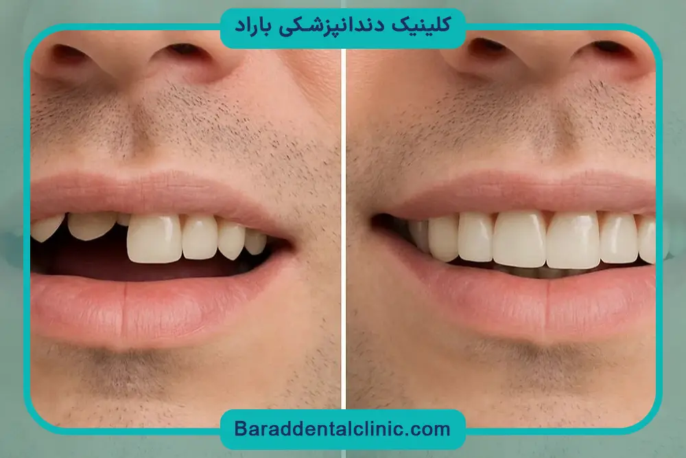 ایمپلنت ثابت دندان