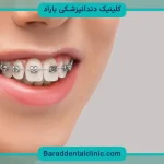 سیم کشی دندان چند سال طول میکشد؟